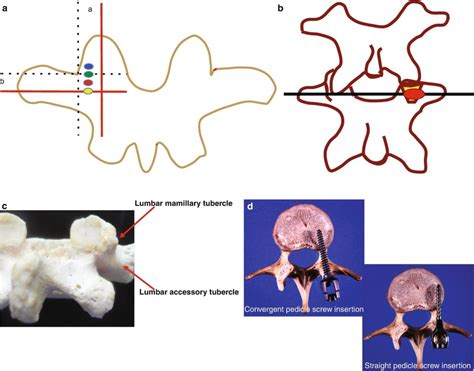 pedisole junction|Surgical Anatomy of the Vertebral Pedicle 